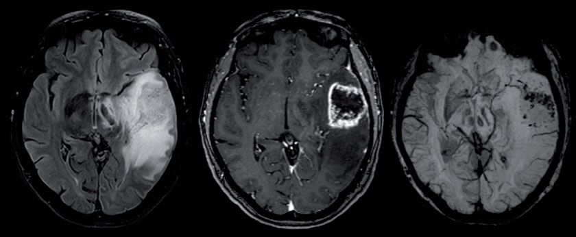 ABBILDUNGEN: FURTNER-SRAJER&KASPRIAN/MEDUNI WIEN (li)Die flüssigkeitsunterdruckte T2-gewichtete (FLAIR) Sequenz zeigt das perifokale Ödem der links temporalen Raumforderung. (mi)Der Tumor ist zentral nekrotisch und zeigt eine deutliche Kontrastmittelaufnahme. (re)Suszeptibilitätsgewichtete Sequenzen zeigen kleine Tumoreinblutungen und drainierende Venolen und Venen.