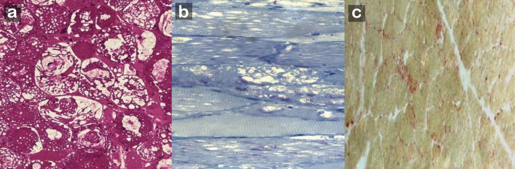 Abbildung 1: Typischer Befund einer Muskelbiopsie eines Patienten mit Morbus Pompe: In der (a) PAS-Färbung ausgeprägte Lipidspeicherung in den Vakuolen, diese stellen sich auch multipel in der (c) sauren Phosphatase positiv dar. (b) Semidünnschnitt mit Darstellung einer ausgeprägten vakuolären Myopathie, zusätzlich finden sich autophagische Vakuolen und einzelne Lipofuscingranula. 