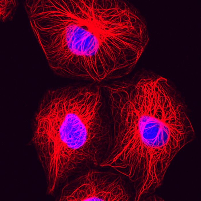 Brustkrebszellen unter dem Mikroskop © Lutz Langbein, DKFZ