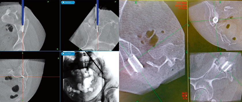 li.: Navigations-Screenshot: Grau ist das intraoperative CT-Bild, blau die virtuelle Projektion des Instruments. re.: Abschlusskontrolle der Lage des Implantats mit O-Arm intraoperativ (würde einem postop. CT-Bild entsprechen). 