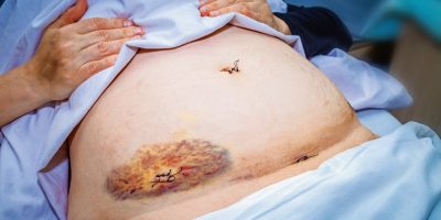 Mammographie mit ernüchternder Bilanz | medonline