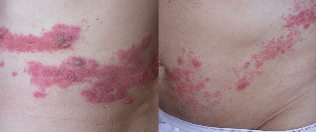 DFP Literaturstudium Herpes zoster ein TherapieUpdate