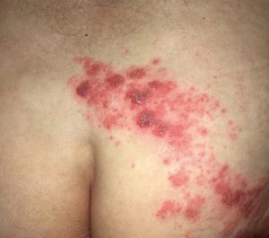 Foto: Klemens Rappersberger Typische Herpes- Zoster-Hautveränderungen auf dem Gesäß; gruppierte Bläschen auf geröteter Haut, beschränkt auf ein Dermatom