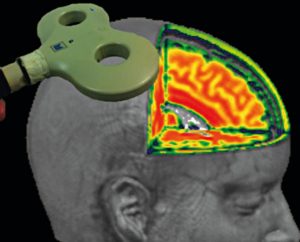Eine stromdurchflossene Spule (o.l.) erzeugt kurzzeitig Magnetfelder, die elektrische Ströme in der Hirnrinde auslösen. Dadurch können Bereiche des Gehirns funktionell stimuliert oder gehemmt werden, hier mittels funktioneller Kernspintomographie schematisch dargestellt. 