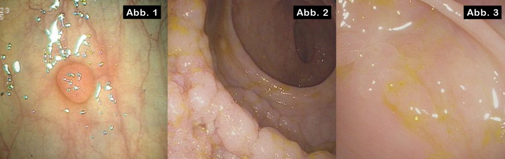 Fotos: KAV/Wilhelminenspital Kleines tubuläres Adenom mit low-grade Dysplasien im Bereich des Colon sigmoideum (Abb. 1); sehr großes tubulovillöses Adenom mit fokalen high-gradeDysplasien im Rektum (Abb. 2); sessiles serratiertes Adenom im Bereich der rechten Flexur. Die Läsion ist schwer von der umgebenden Schleimhaut abzugrenzenund zeigt einen „rim of debris“. (Abb. 3)