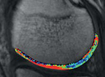 Frühe Schädigung des Knorpels im Bereich der Druckaufnahmezone des medialen Femurkondylus, das sich in einer unterschiedlichen biochemischen Zusammensetzung zeigt (mehr blau gegenüber rot). 