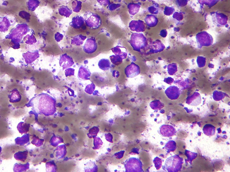 © Nephron, Wikimedia Commons B-Zell-Lymphom