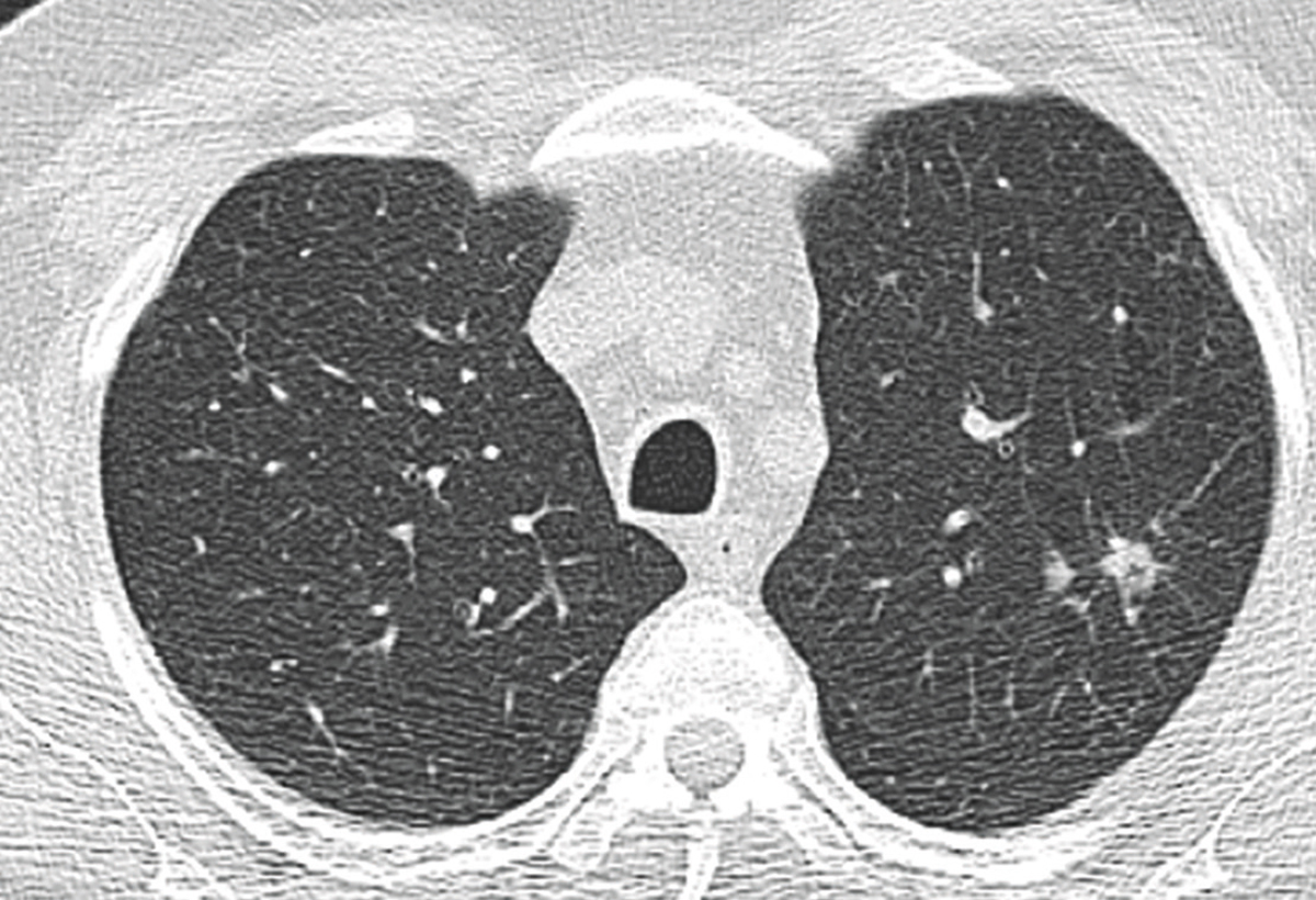 Lungenrundherde: Frühdiagnose ist möglich | CliniCum pneumo