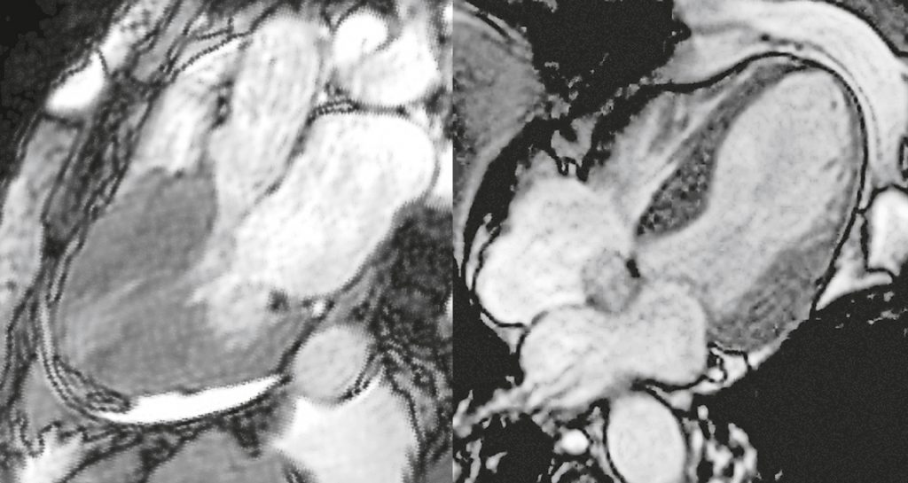 Nur im MRT-Bild kann man eine hypertrophe Kardiomyopathie (links) von einer Amyloidose und ein akutes Tako-Tsubo-Syndrom (rechts) von einer Myokarditis unterscheiden.