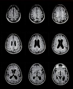 mri of brain showing multiple sclerosis
