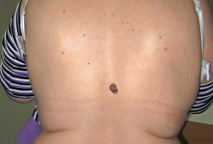 Foto: Abteilung für Dermatologie und Venerologie, Rudolfstiftung Superfiziell-spreitendes Melanom (SSM) mit nodulärem Anteil T2a