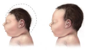 Centers for Disease Control and Prevention - http://www.cdc.gov/ncbddd/birthdefects/images/microcephaly-comparison-500px.jpg