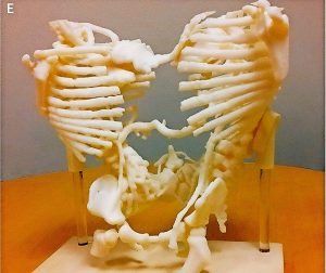FOTO: THE NEW ENGLAND JOURNAL OF MEDICINE ©2017 Aus dem 3D-Drucker: Modell von Skelett und Gefässverbindungen.