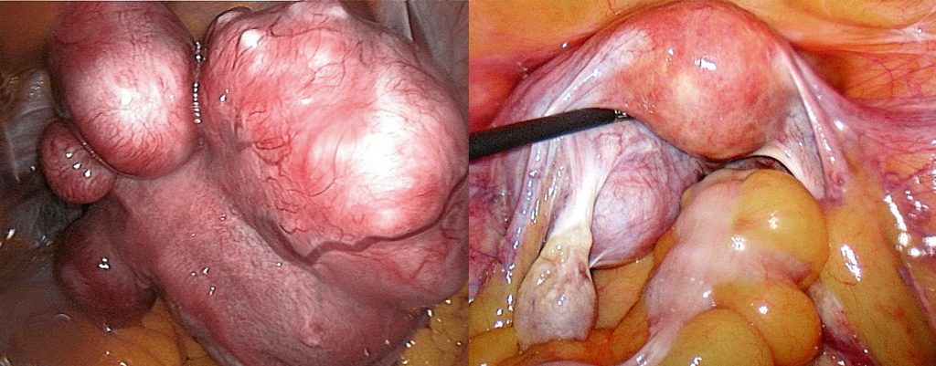 Bild li.: mehrknolliger Uterus myomatosus Bild re.: großes intraligamentäres Myom des linken Ligamentum latum 