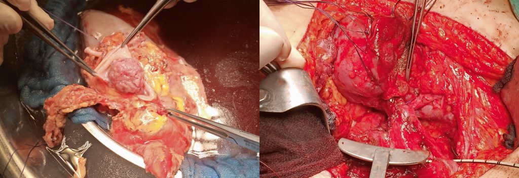 FOTOS: WGKK-HANUSCH-KH links: Die explantierte Niere wird auf Eis gelagert, in der Bildmitte ist der Tumor zu erkennen. rechts: Niere nach Entfernung des Tumors mit Darstellung der Verbindung zwischen Blase und Niere.