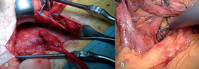a) Bruchpfortenverschluss nach Lichtenstein nach Netzimplantation b) Fundoplicatio; nach Präparation der beiden Zwerchfellschenkel und des retroösophagealen Fensters 