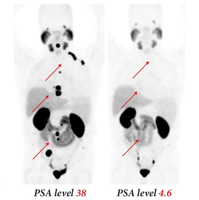 PMSA-617, markiert mit einem therapeutischen Radionuklid, ließ bei vielen Prostatakrebspatienten den PSA-Spiegel stark abfallen und die Metastasen schrumpfen oder sogar ganz zurückgehen (PET-Aufnahmen vor und nach der Behandlung).
