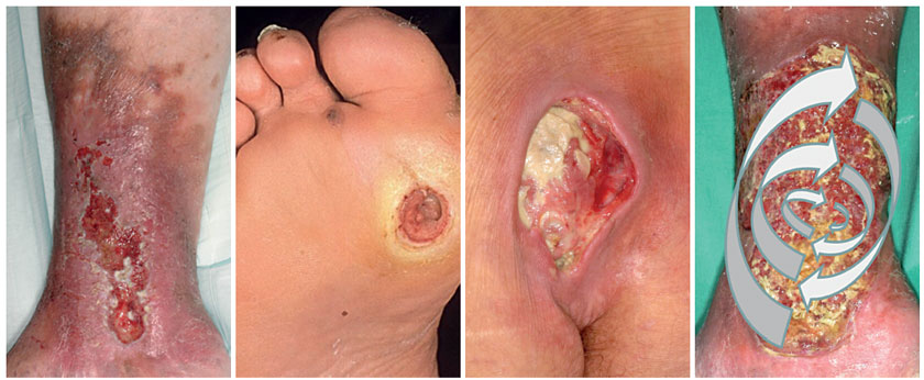 Fotos: Dissemond Abb. 1: Patient mit einem seit mehreren Jahren bestehenden Ulcus cruris venosum Abb. 2: Patientin mit diabetischem Fußulcus bei ausgeprägter Polyneuropathie Abb. 3: Immobile Patientin mit sakral lokalisiertem Dekubitus Abb. 4: Essener Kreisel für eine Screening-Untersuchung auf Bakterien bei einem Patienten mit Ulcus cruris venosum