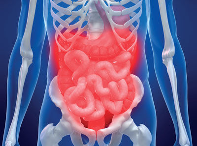 Viele Rheumapatienten weisen entzündliche Veränderungen im Darm auf.
