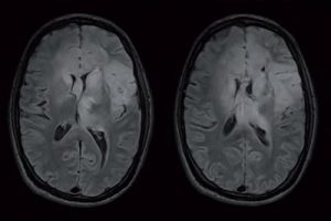 Therapie der LowGradeGliome