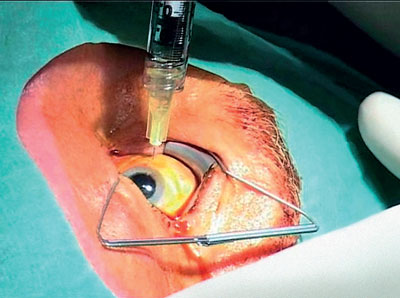  Intravitreale operative Medikamentenapplikation (IVOM): Antikörper werden in das Augeninnere injiziert. 