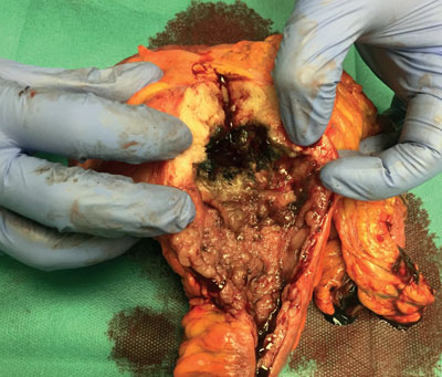 Das Operationspräparat nach rechtsseitiger Hemikolektomie zeigt einen 15x10cm messenden Tumor
