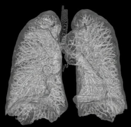 3D-Rekonstruktion menschlicher Lunge aus CT-Bildern