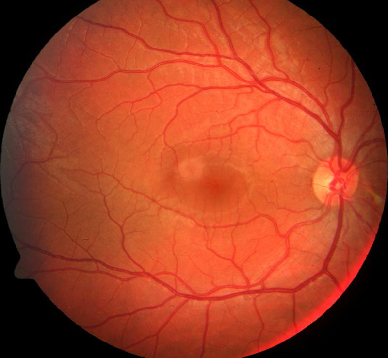 Netzhaut des Auges beim Blick durch den Fundus: Mit dem Muster-ERG wird die Aktivität der Ganglienzellen gemessen. Bei Personen mit ADHS zeigen die Zellen ein erhöhtes Hintergrundrauschen.