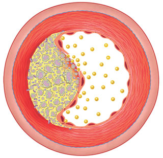 Arteriosklerotische Plaque: In der oxidativen Modifizierung von LDL wird die eigentliche Ursache für die Initiierung des Geschehens gesehen. 
