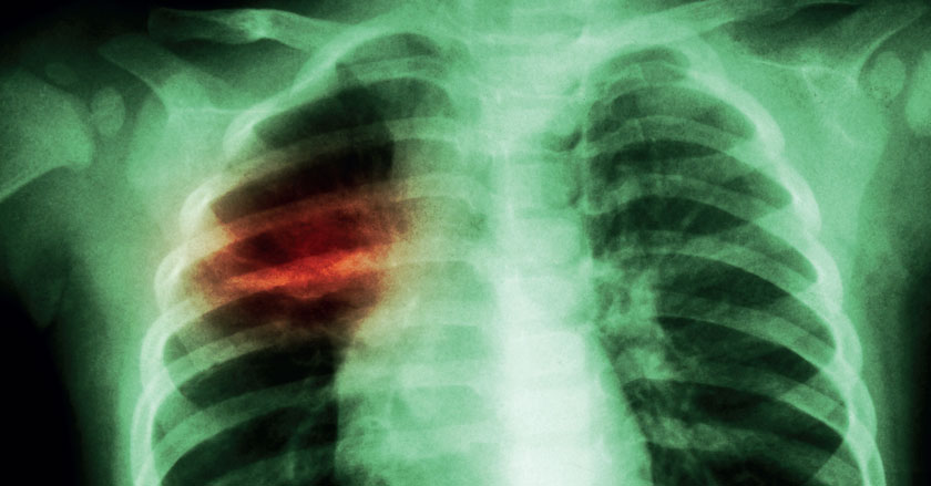 Lungenröntgen eines Kindes mit Infiltration, rechter mittlerer Lungenflügel mit Mycobacterium tuberculosis